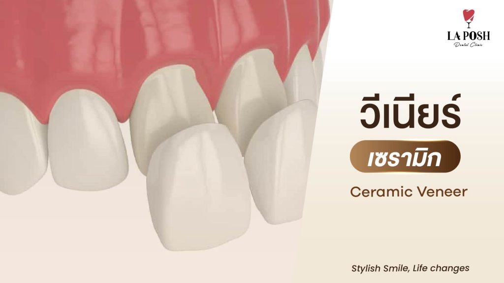 ทำวีเนียร์แบบเซรามิก (Ceramic Veneer)