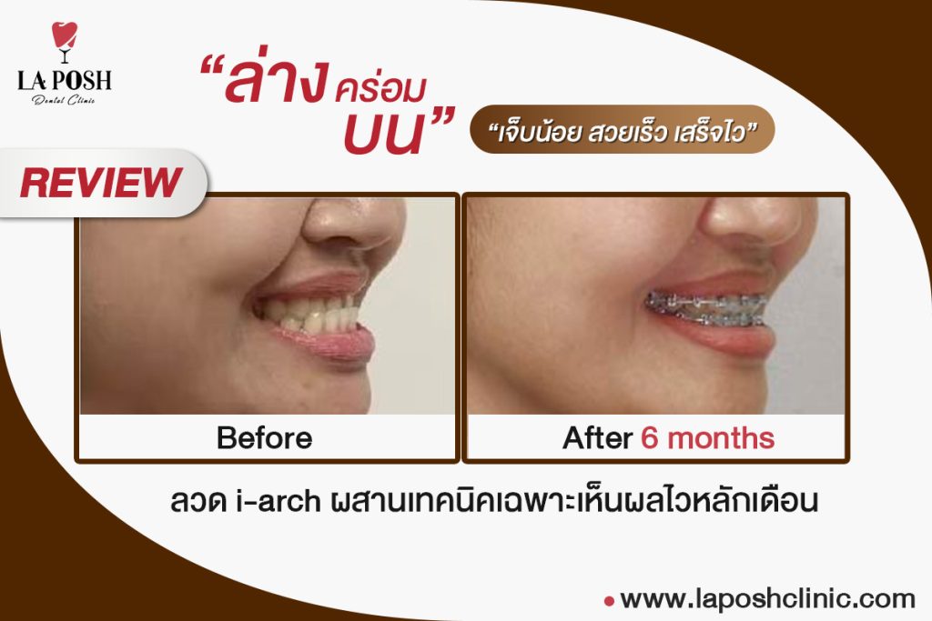 หลังถอดเหล็กจัดฟันควรดูแลฟันอย่างไร? 10 วิธีดูแลรอยยิ้มหลังจัดฟันให้สวยนาน 2 Review ล่างคร่อมบน 6 เดือน 1 0