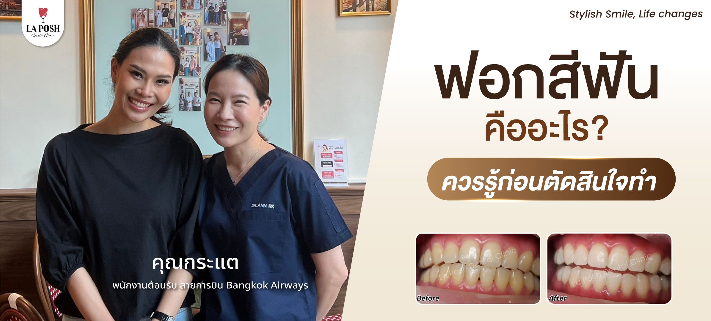 การฟอกสีฟันคืออะไร? ข้อดีและข้อเสียที่ควรรู้ก่อนตัดสินใจทำ 1 36-01