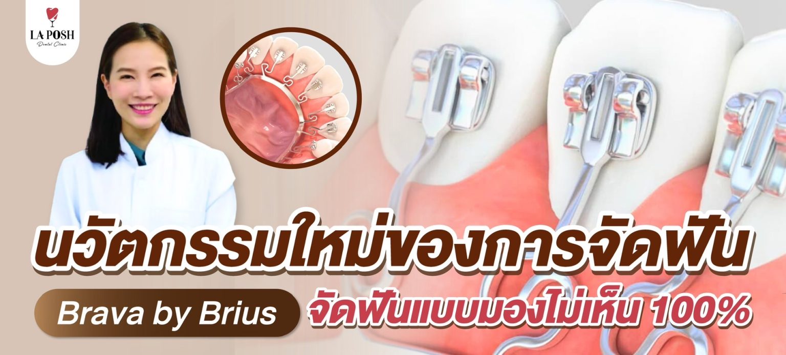 โปรโมชั่นจัดฟัน Brava 1 จัดฟันด้านใน Brava by Brius นวัตกรรมใหม่ของการจัดฟัน