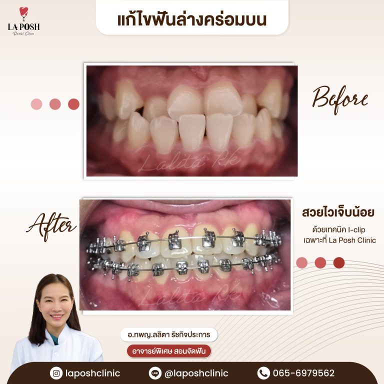 จัดฟันเด็ก 30 ผลจัดฟันเด็กก่อน-หลัง ที่ La Posh Dental Clinic
