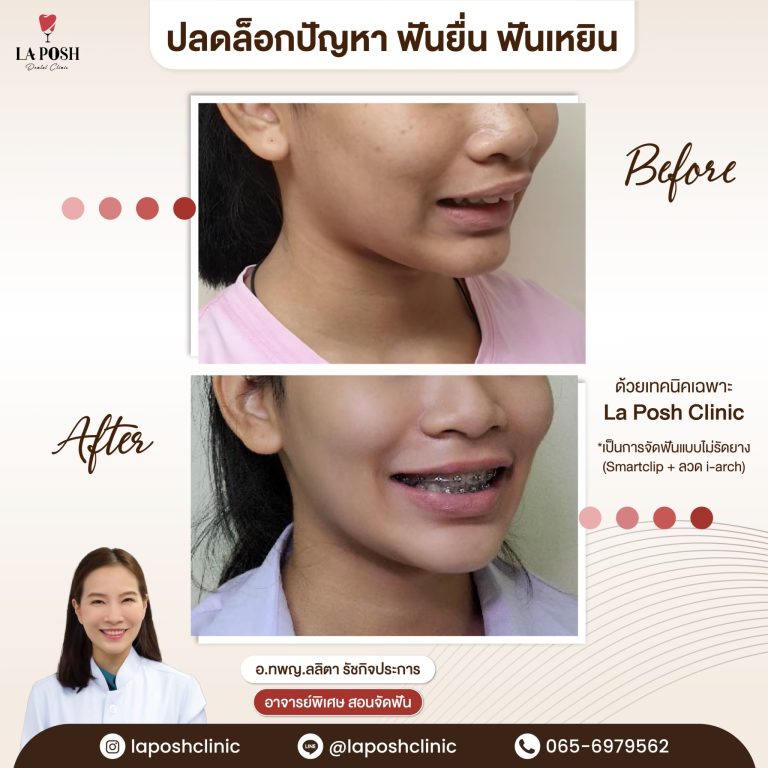 จัดฟันเด็ก 28 ผลจัดฟันเด็กก่อน-หลัง ที่ La Posh Dental Clinic