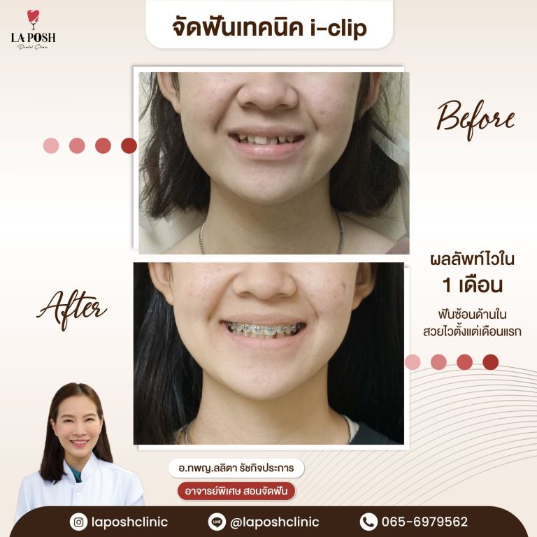 จัดฟันเด็ก 27 ผลจัดฟันเด็กก่อน-หลัง ที่ La Posh Dental Clinic
