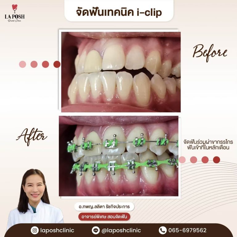 จัดฟันเด็ก 26 ผลจัดฟันเด็กก่อน-หลัง ที่ La Posh Dental Clinic