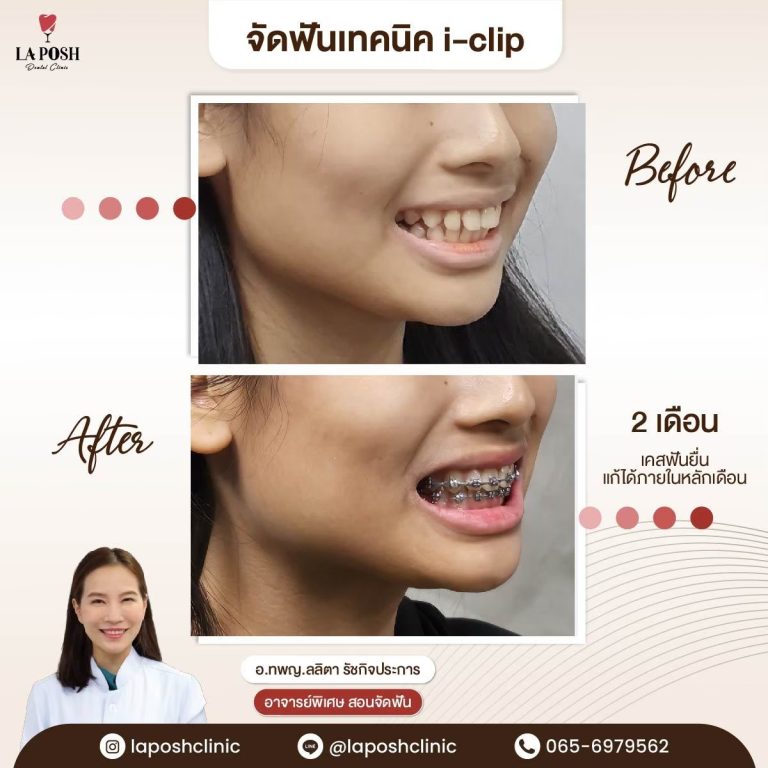 จัดฟันเด็ก 24 ผลจัดฟันเด็กก่อน-หลัง ที่ La Posh Dental Clinic