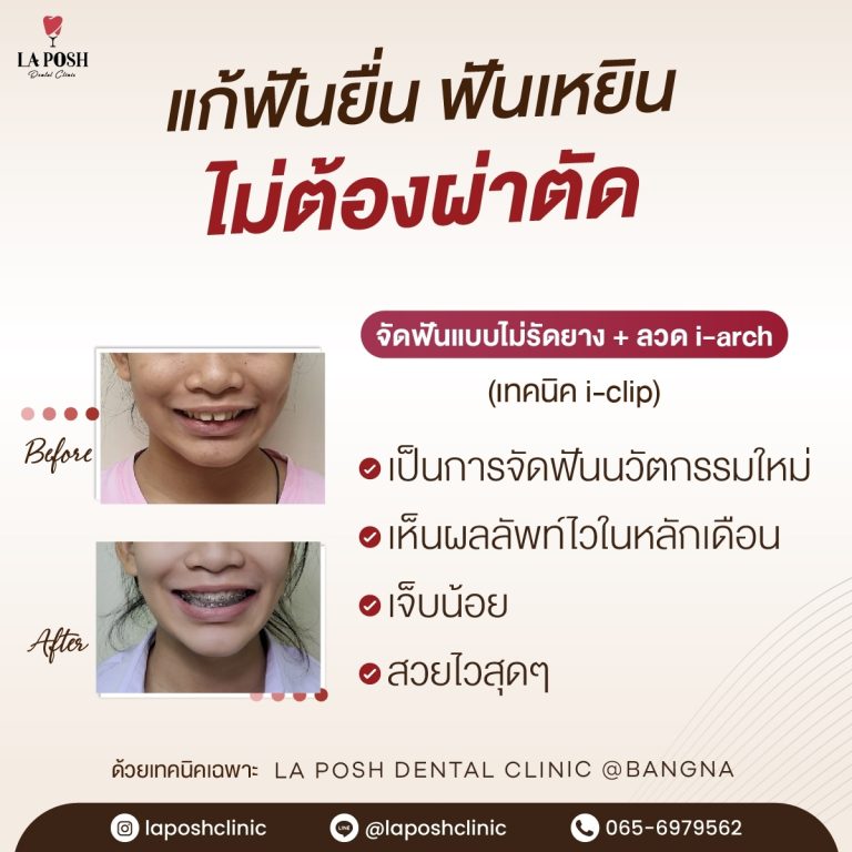 จัดฟันเด็ก 21 จัดฟันเด็ก ที่ La Posh Dental Clinic
