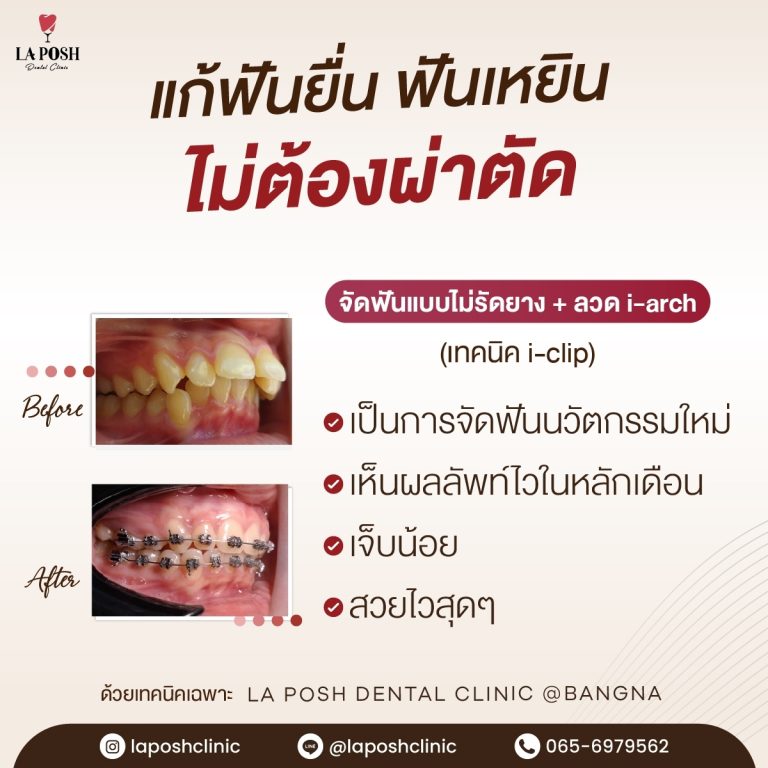 จัดฟันเด็ก 20 จัดฟันเด็ก ที่ La Posh Dental Clinic