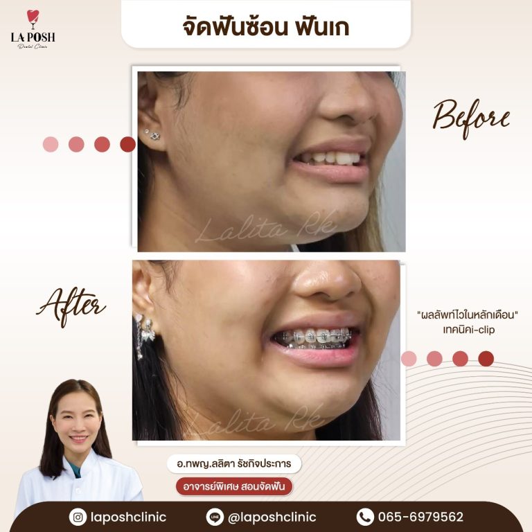 จัดฟัน i arch 11 รีวิวก่อน-หลังจัดฟันแบบดามอน Damon ด้วย i-clip แก้ปัญหาฟันเก ฟันซ้อน