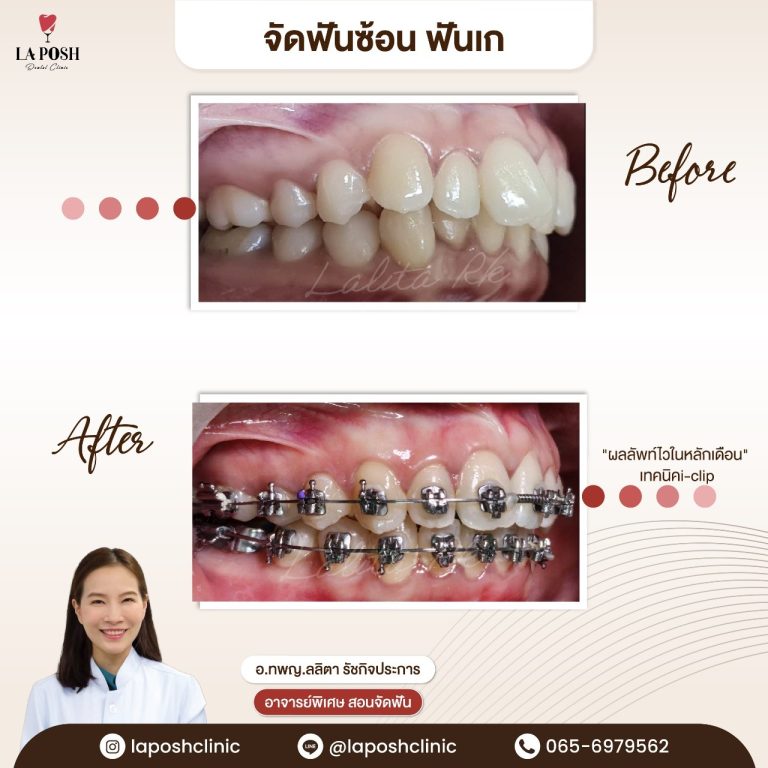 จัดฟัน i arch 12 รีวิวเคสจัดฟันแบบดามอน Damon ด้วย i-clip ก่อน-หลัง แก้ปัญหาฟันเก ฟันซ้อน