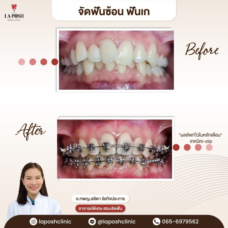 จัดฟัน i arch 13 รีวิวเคสจัดฟันแบบดามอน Damon ด้วย i-clip ก่อน-หลัง
