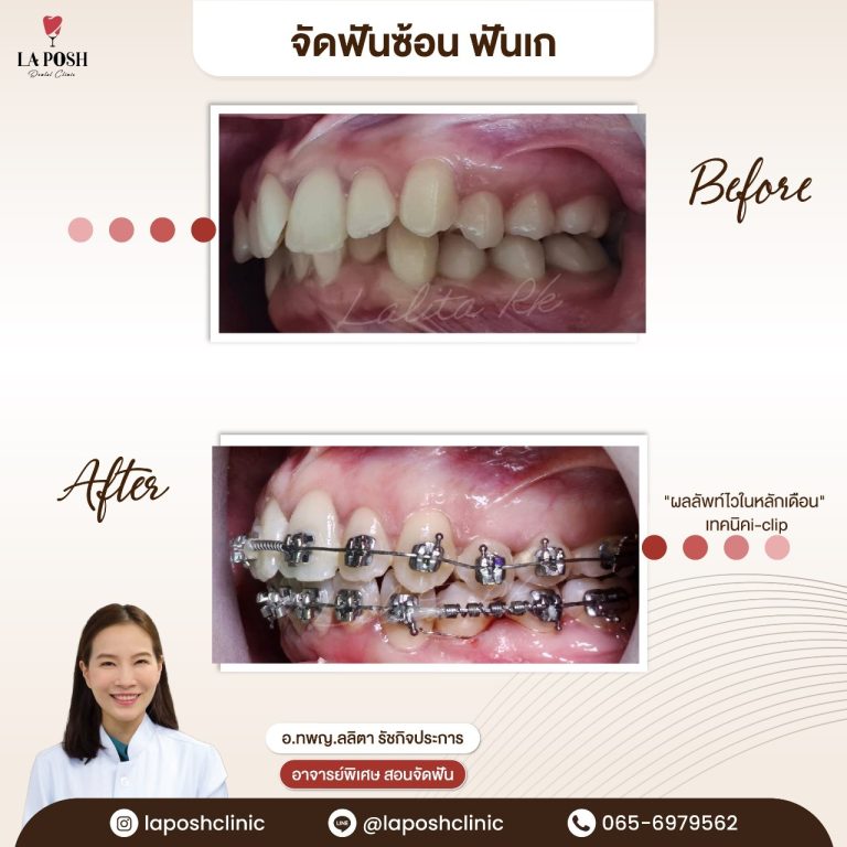 จัดฟัน i arch 14 รีวิวจัดฟันแก้ฟันยื่น ฟันเหยินด้วยดฟันแบบดามอน เทคนิค i-clip