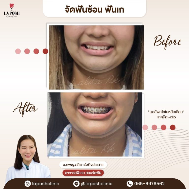 จัดฟัน i arch 15 รีวิวจัดฟันแบบดามอน แก้ฟันยื่น ฟันเหยินด้วยเทคนิค i-clip