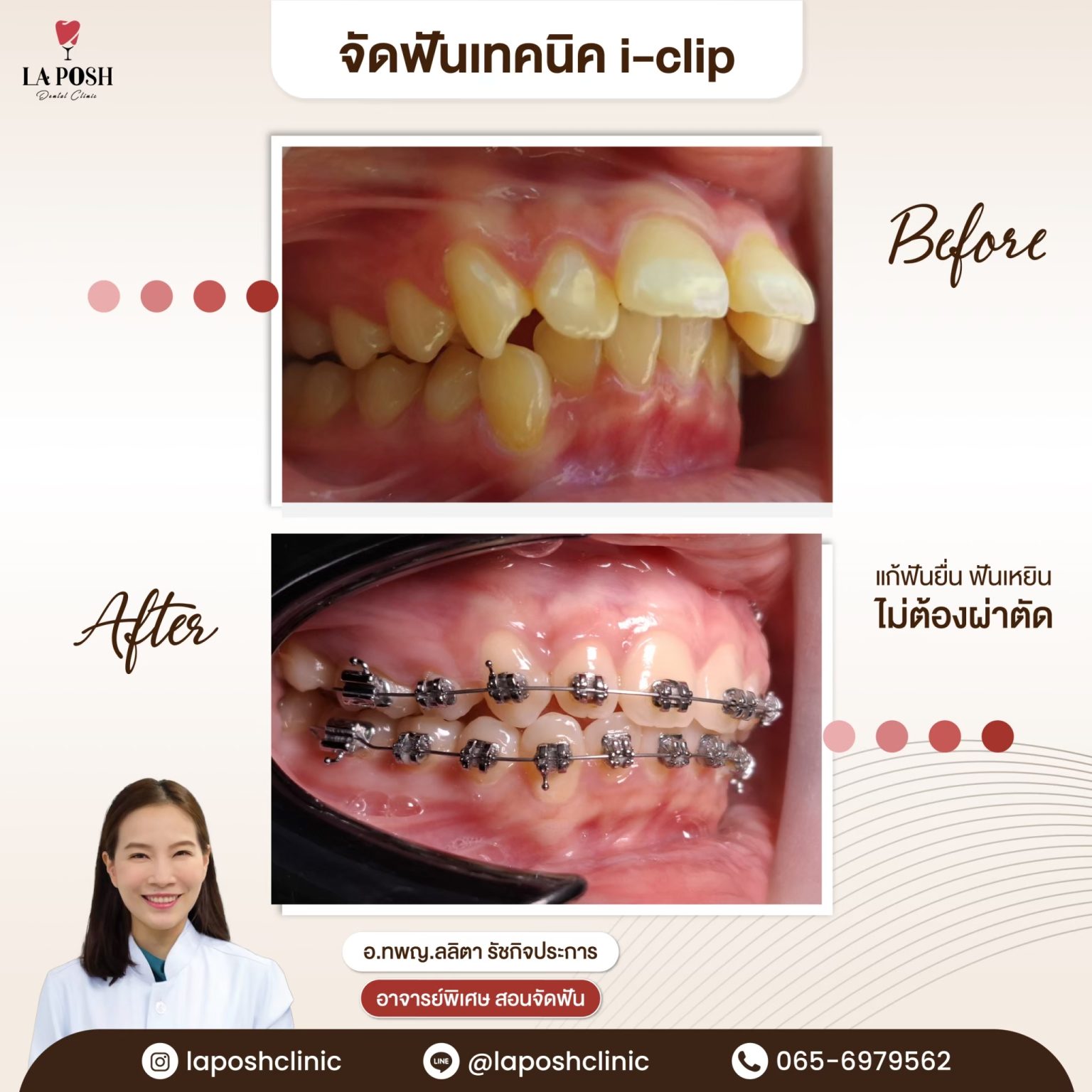 จัดฟันเหล็ก เทคนิค i-Zip 25 รีวิวจัดฟันแบบดามอน แก้ปัญหาฟันยื่น ฟันเหยิน เทคนิค i-clip