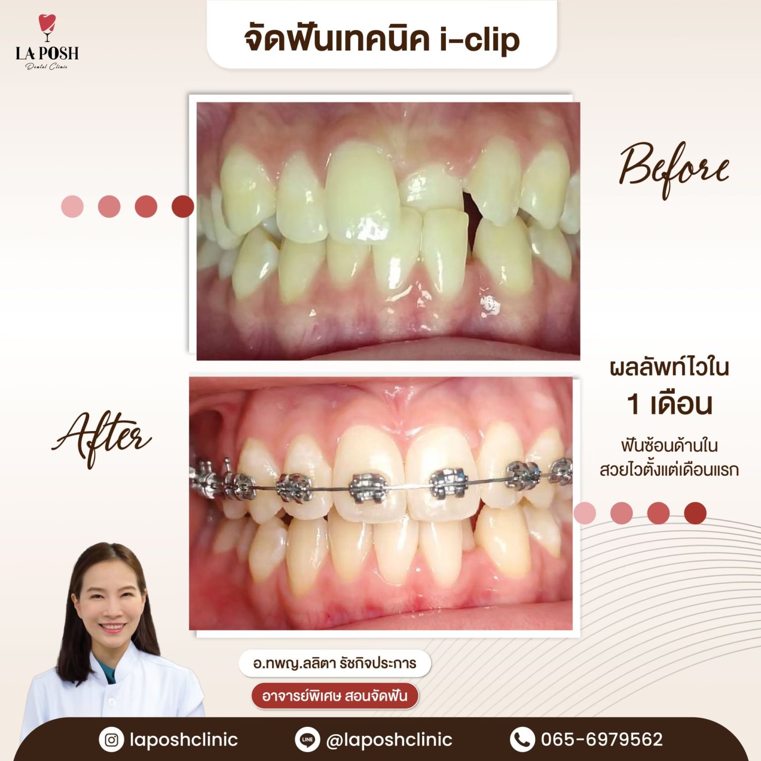 จัดฟันเหล็ก เทคนิค i-Zip 27 รีวิวจัดฟันแบบดามอน ด้วยเทคนิค i-clip แก้ฟันยื่น ฟันเหยิน