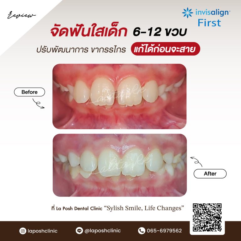 จัดฟันเด็ก 35 รีวิวเคสจัดฟันใสสำหรับเด็ก 6-12 ปีกับหมอฟันเด็ก