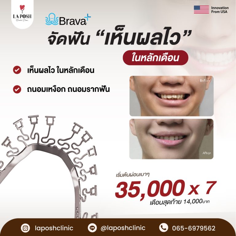 จัดฟัน Brava 9 โปรโมชั่นจัดฟันแบบมองไม่เห็น Brava ที่ La Posh Dental Clinic