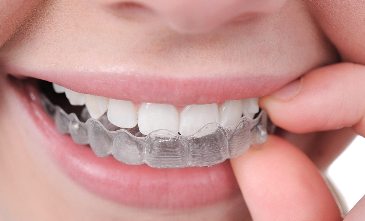 จัดฟันใส invisalign ข้อดี