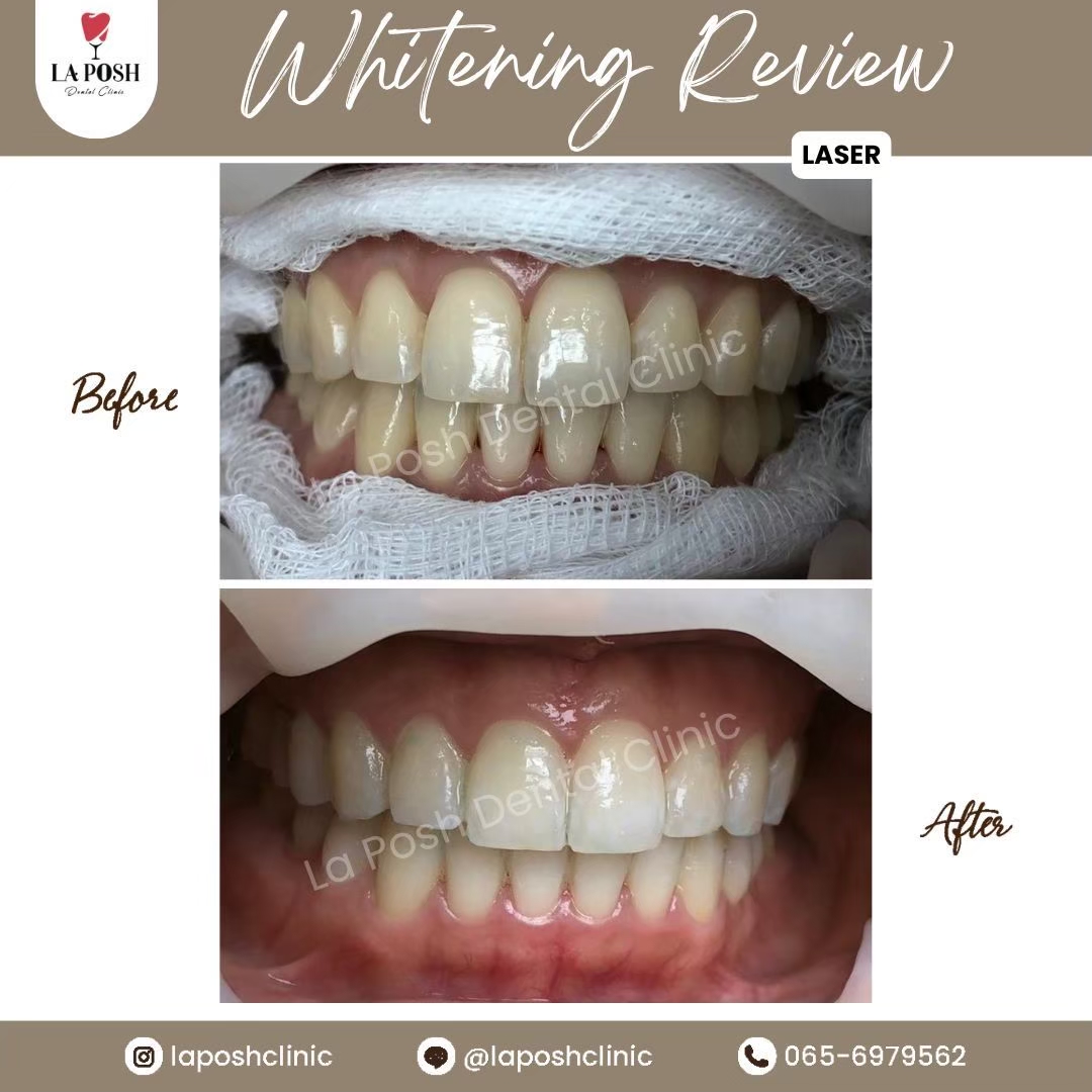 รีวิวก่อน-หลังฟอกสีฟัน