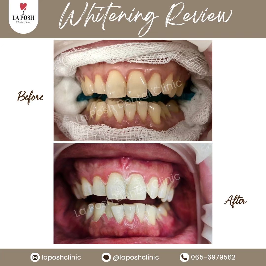 รีวิวก่อน-หลังฟอกสีฟัน แก้ปัญหาฟันเหลือง