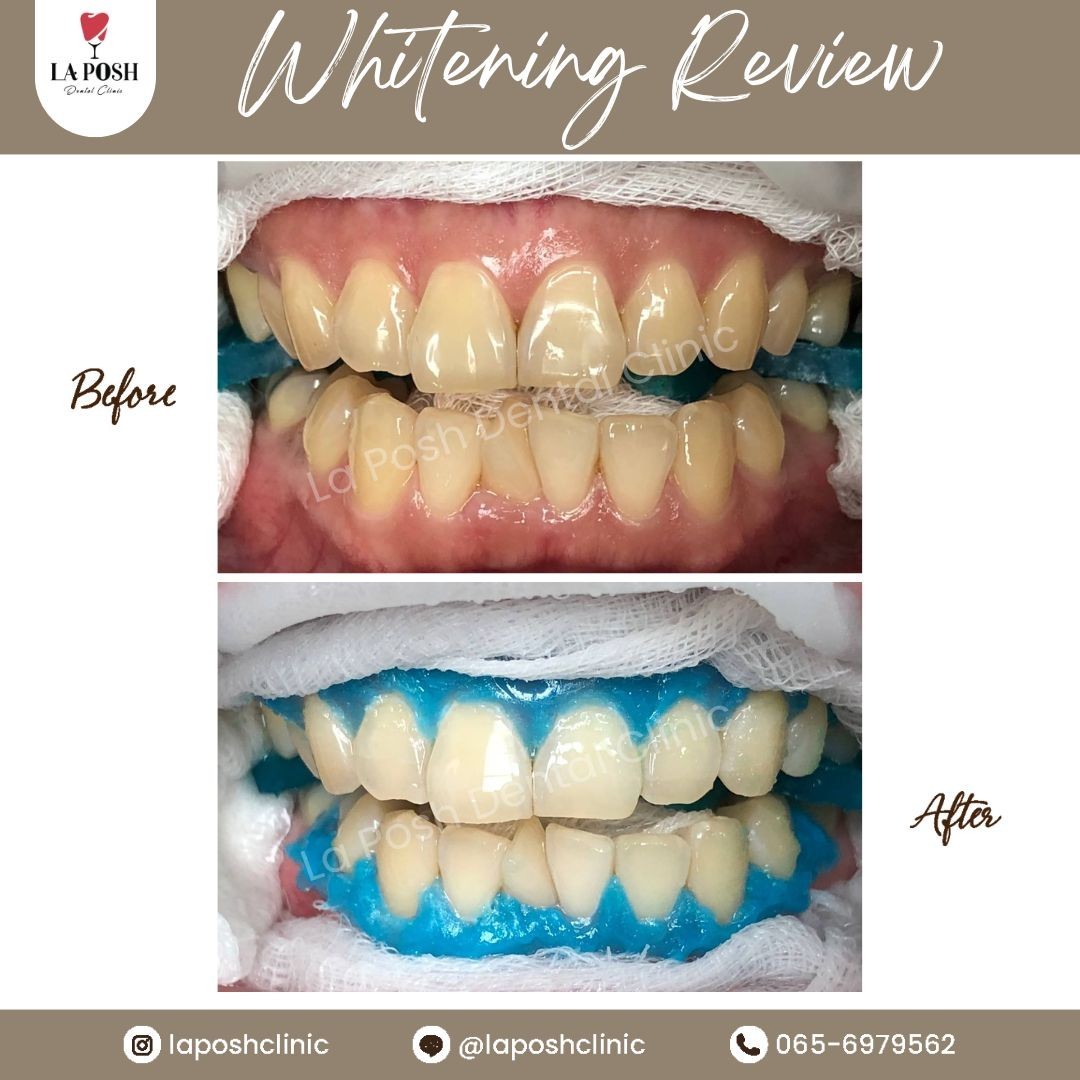 รีวิวก่อน-หลังฟอกสีฟันให้กลับมายิ้มมั่นใจที่ Laposh Dental Clinic
