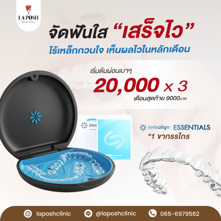 จัดฟันใส Invisalign คืออะไร เหมาะกับใคร ราคาเท่าไหร่? 5 Promotion-จัดฟันใส1