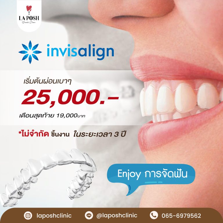 จัดฟันใส Invisalign คืออะไร เหมาะกับใคร ราคาเท่าไหร่? 6 Promotion-จัดฟันใส3