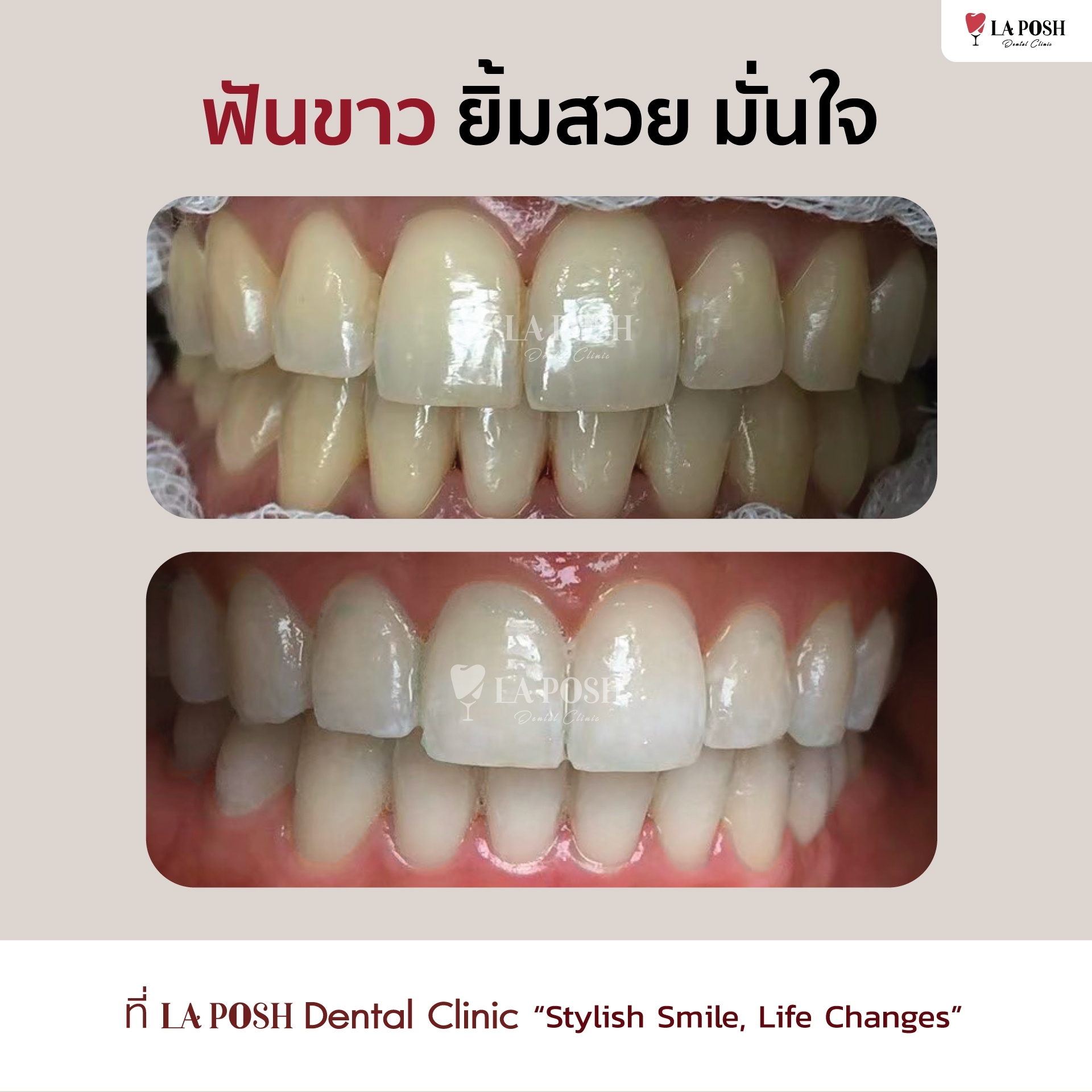 รีวิวก่อน-หลังฟอกสีฟัน แก้ปัญหาฟันเหลืองที่ Laposh Dental Clinic