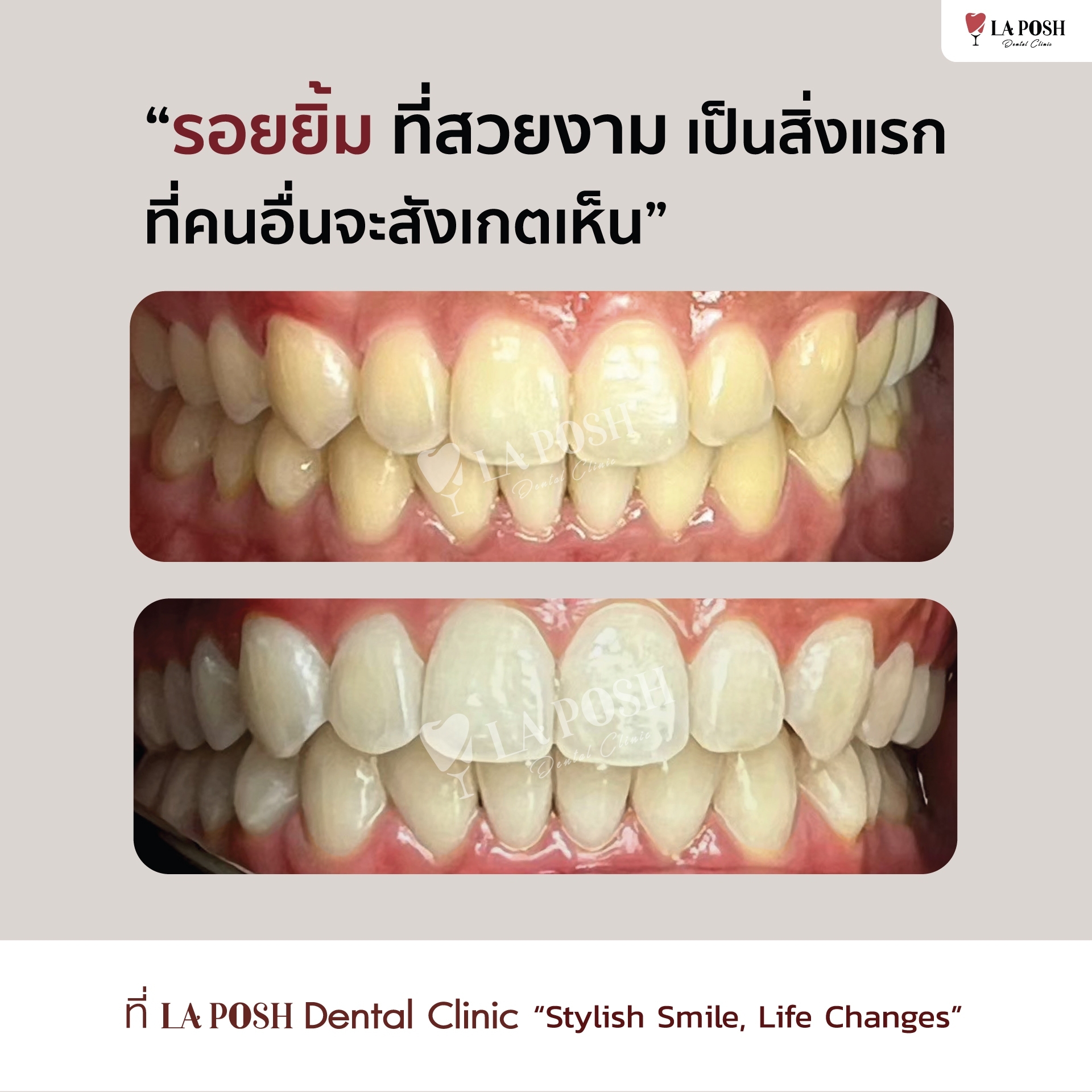 รีวิวก่อน-หลังฟอกสีฟันที่ Laposh Dental Clinic ให้กลับมามั่นใจ