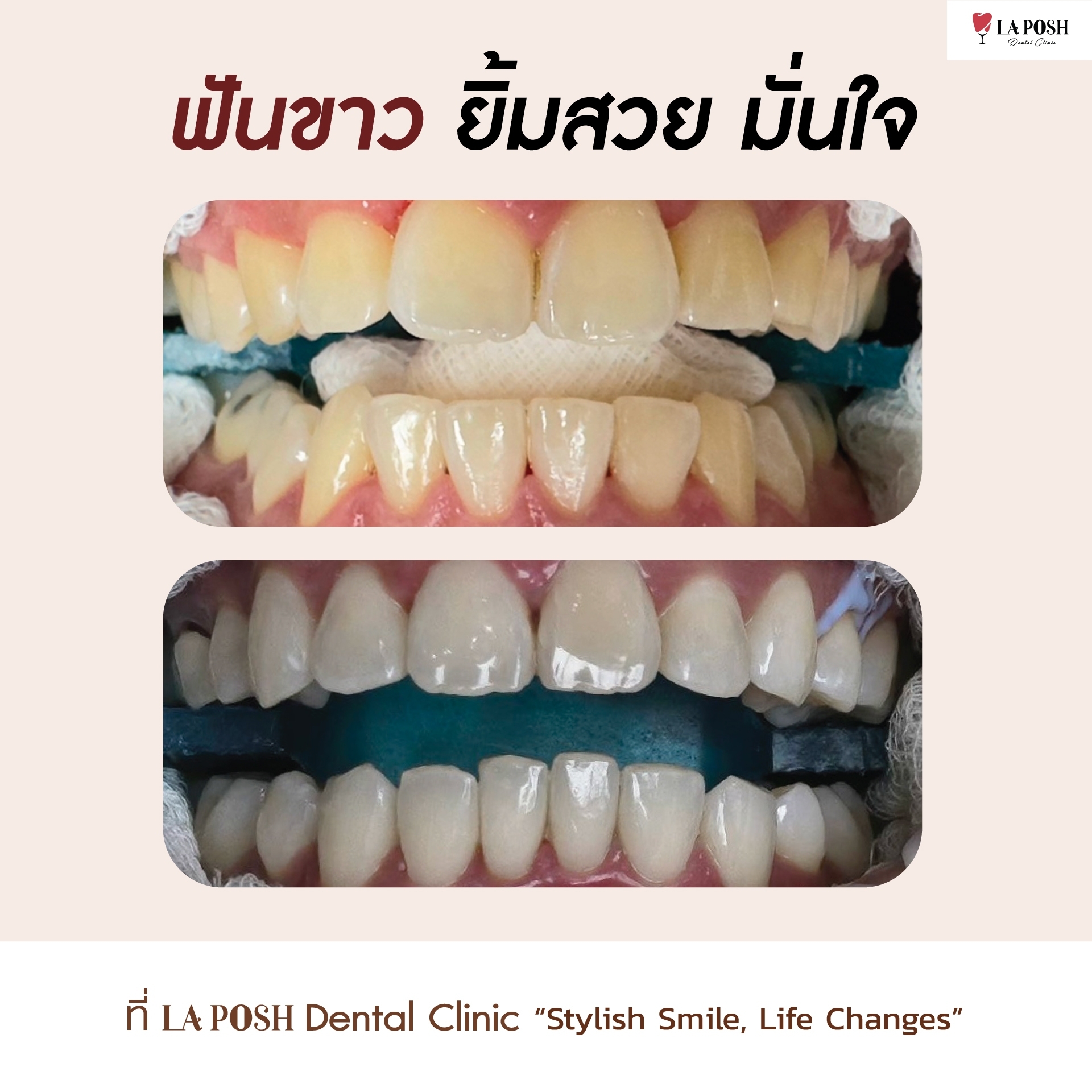รีวิวก่อน-หลังฟอกสีฟัน ฟันขาว ยิ้มสวย มั่นใจ