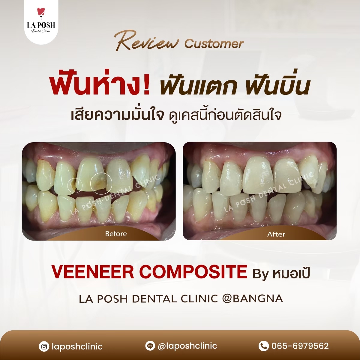 รีวิวก่อน-หลังทำวีเนียร์ แก้ปัญหาฟันห่าง ฟันแตก ฟันบิ่น