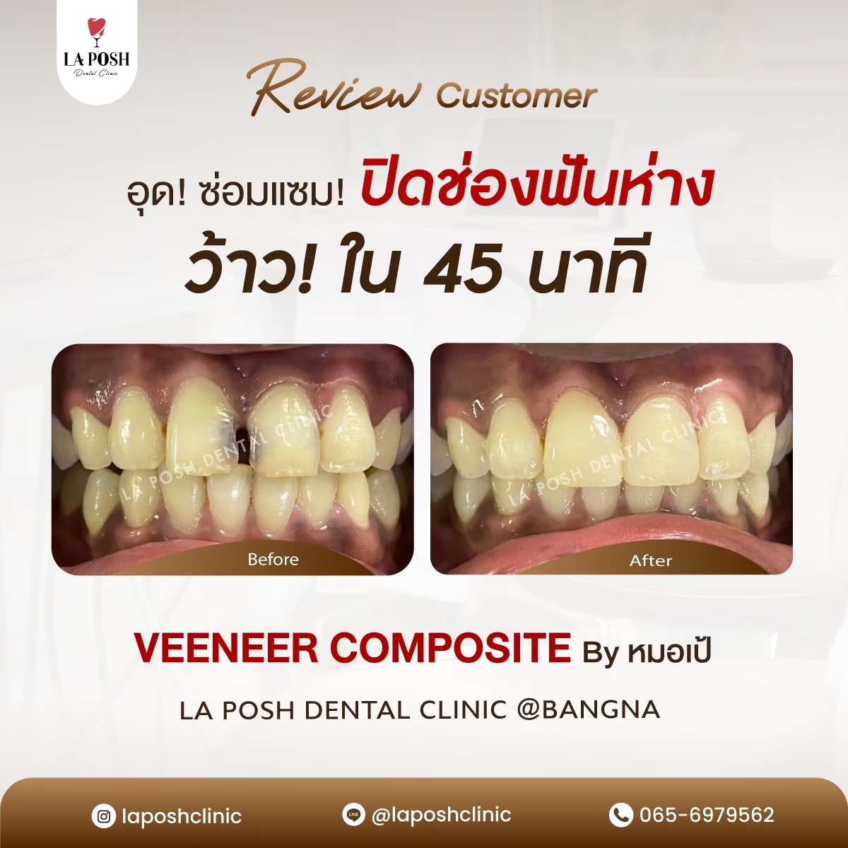 รีวิวก่อน-หลังทำวีเนียร์ ปิดช่องว่างฟัน