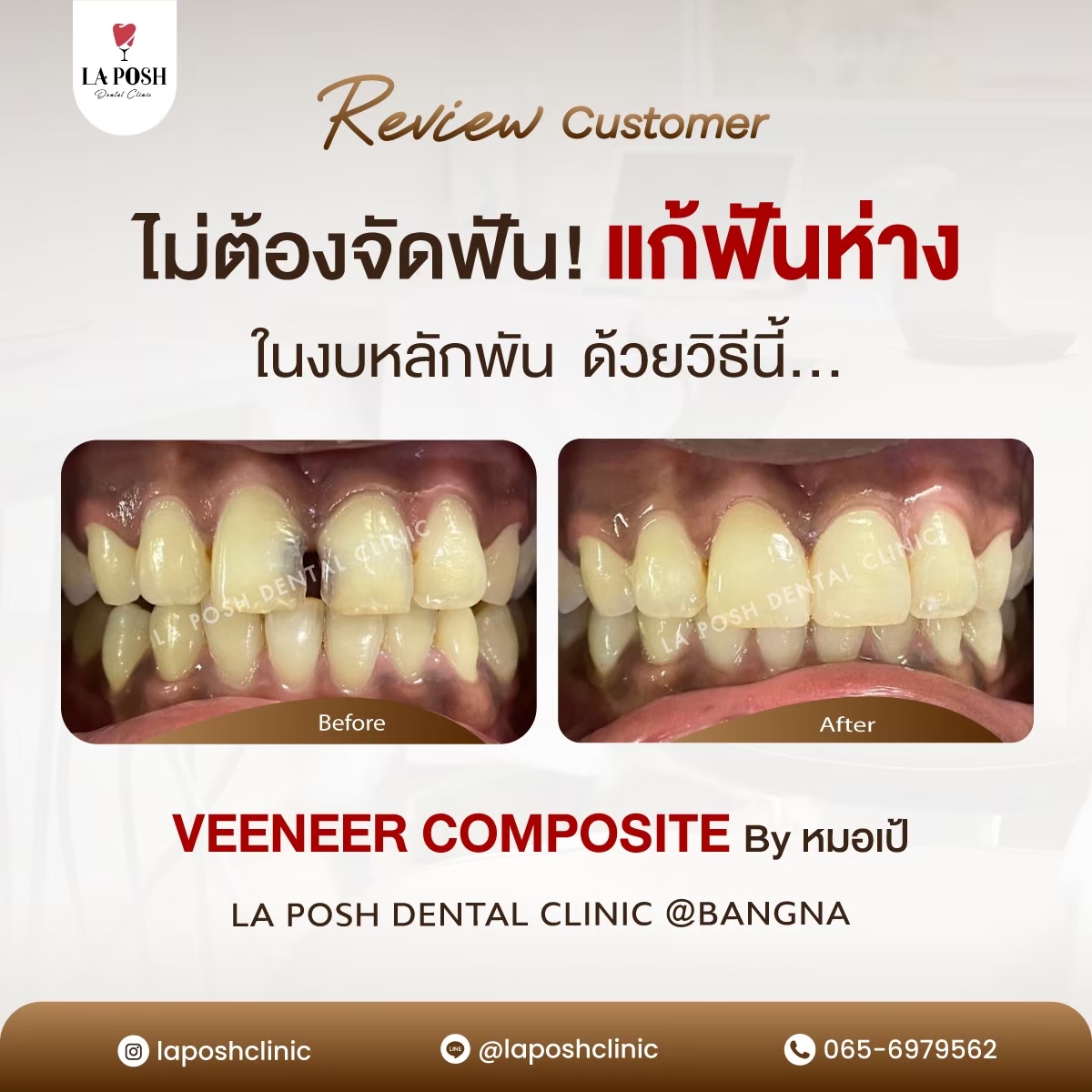 รีวิวก่อน-หลังทำวีเนียร์ แก้ฟันห่าง
