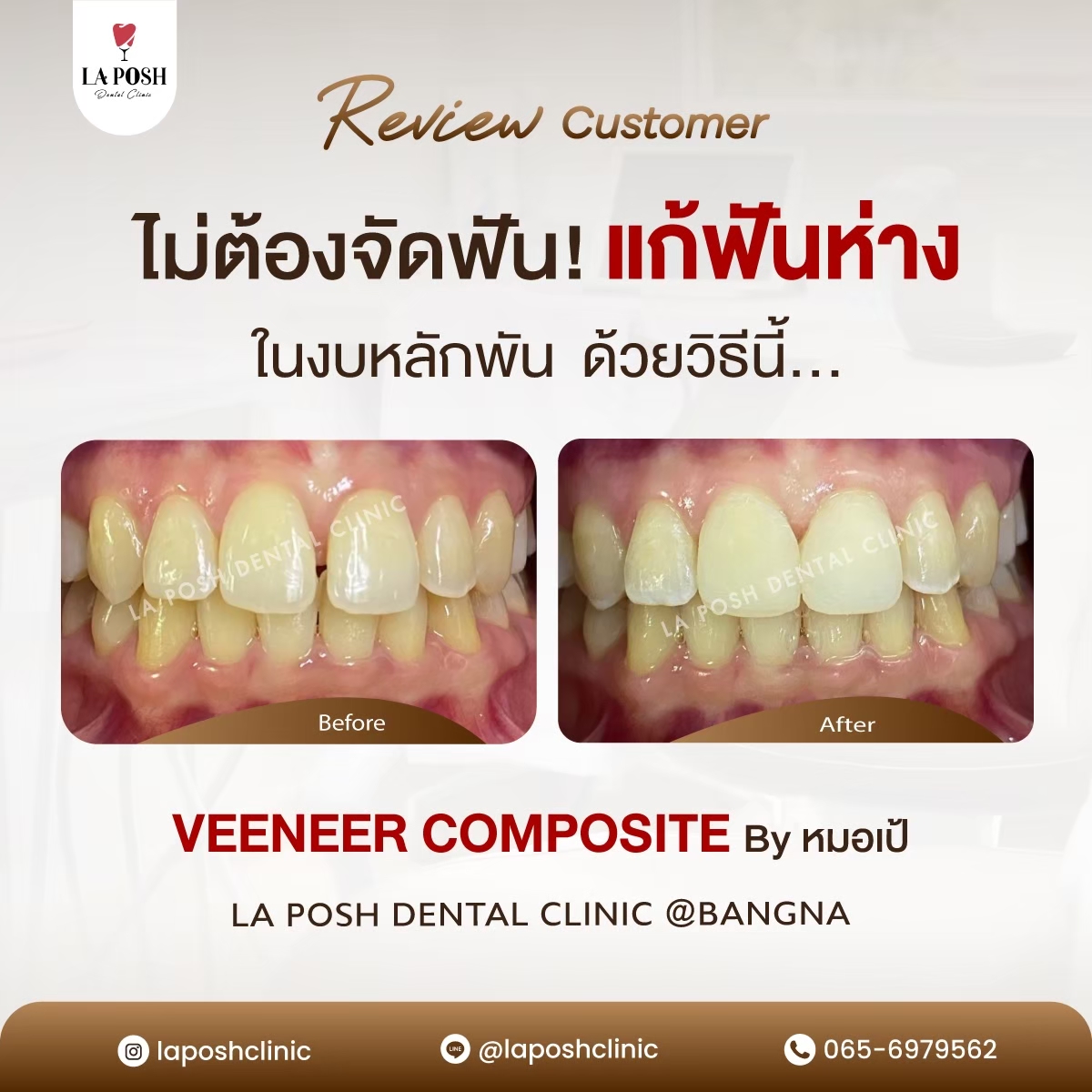 รีวิวก่อน-หลังทำวีเนียร์ แก้ฟันห่าง งบหลักพัน