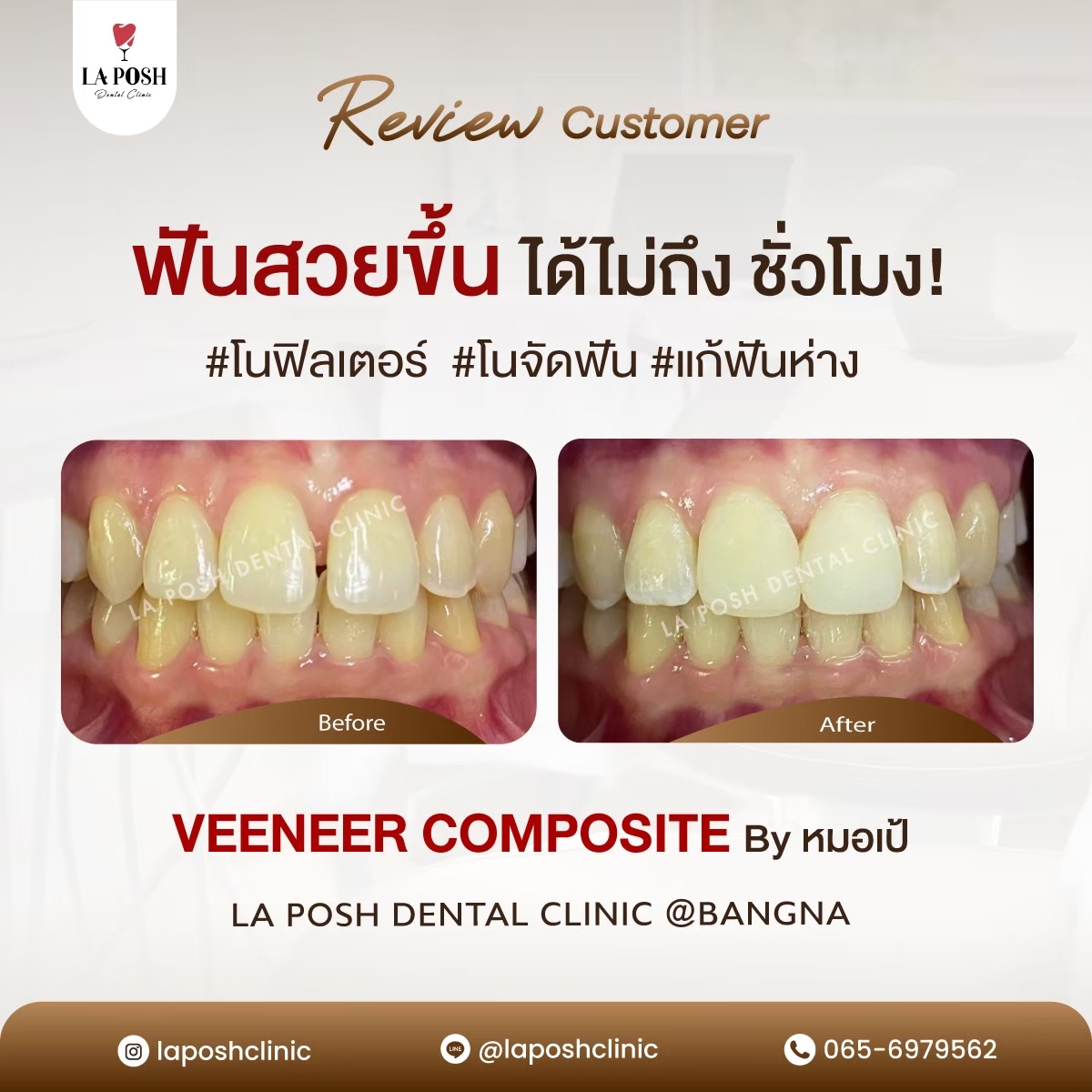 รีวิวก่อน-หลังทำวีเนียร์ แก้ปัญหาฟันห่าง