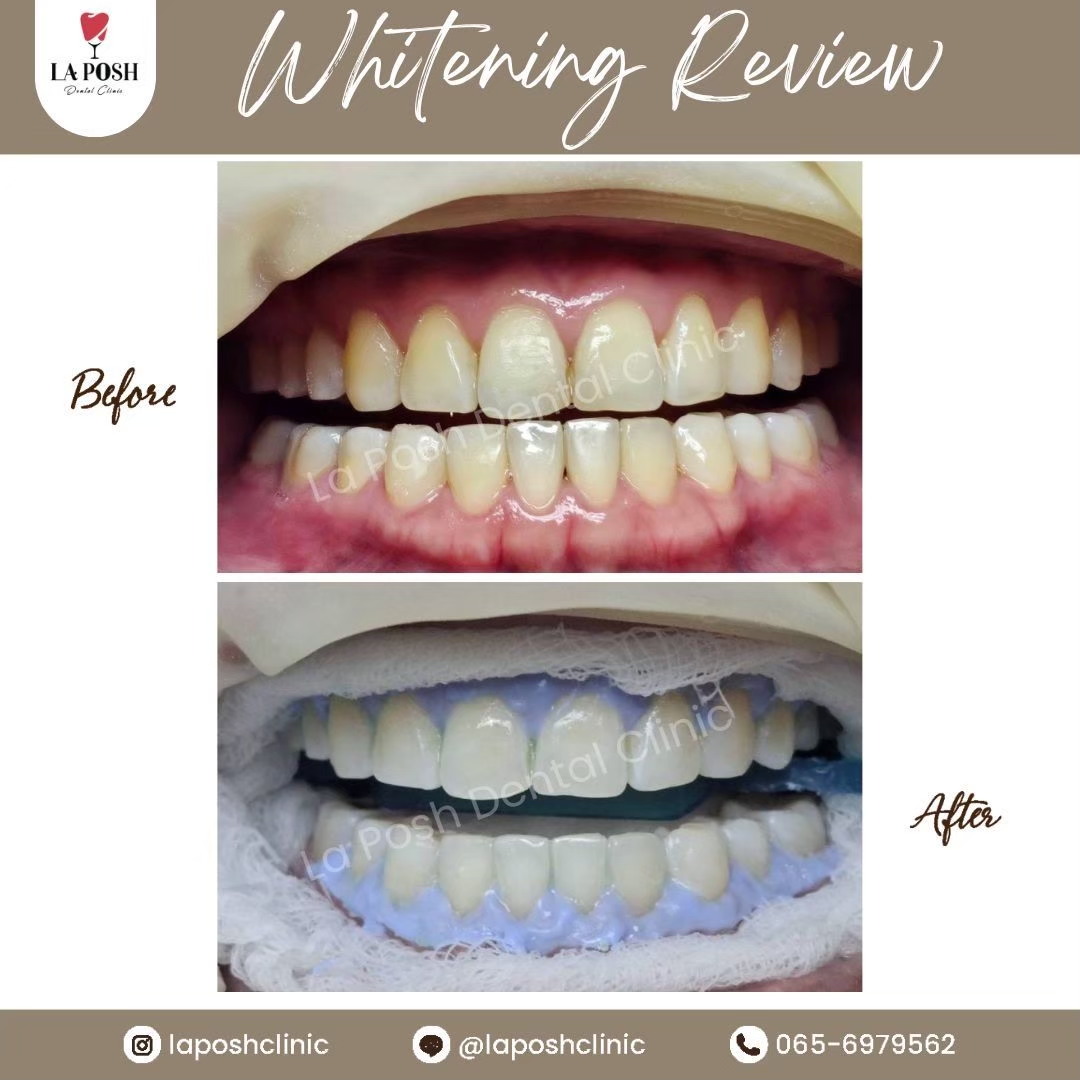 Teeth Whitening Bangkok 6 Before - After teeth whitening bangkok