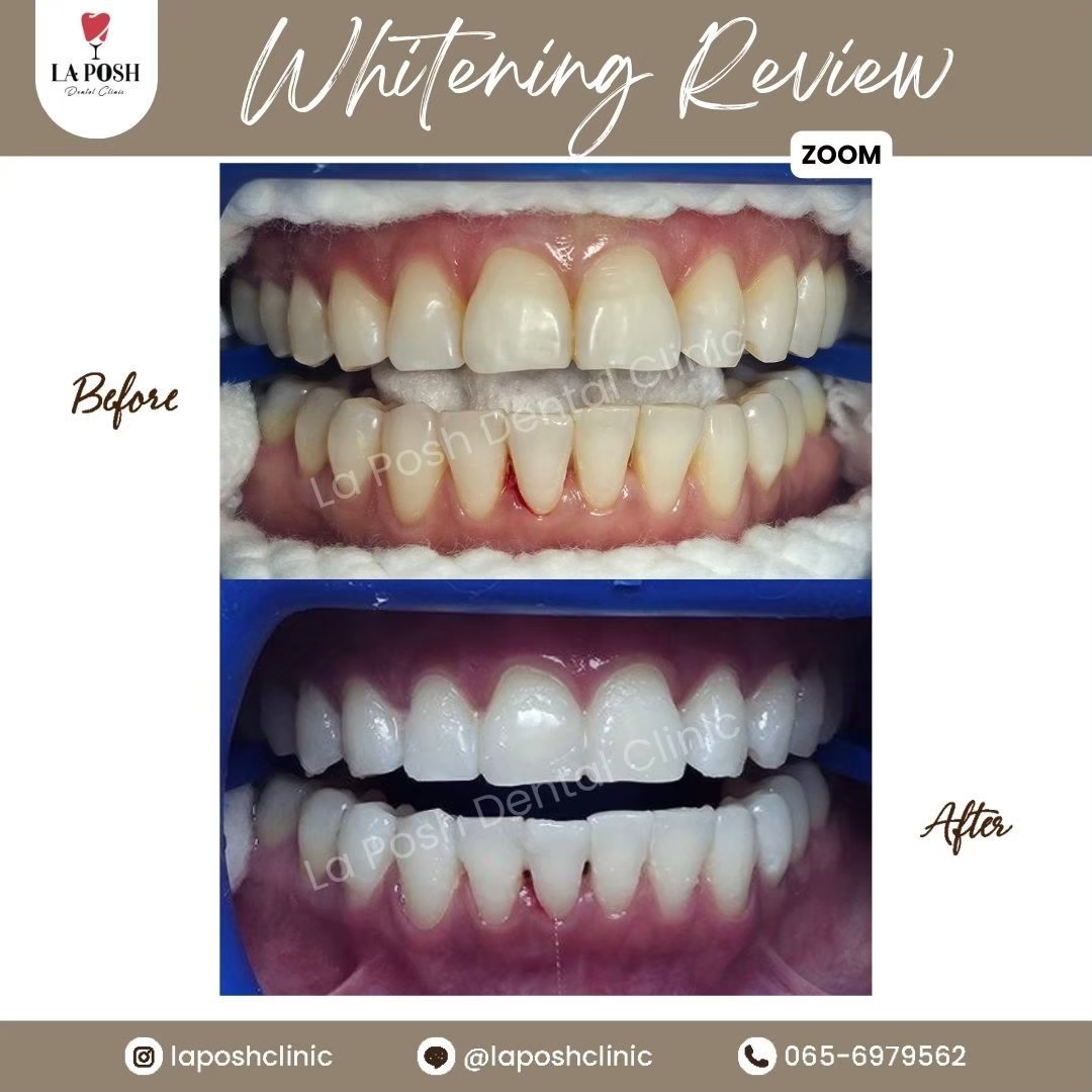 Teeth Whitening Bangkok 5 Before - After teeth whitening bangkok