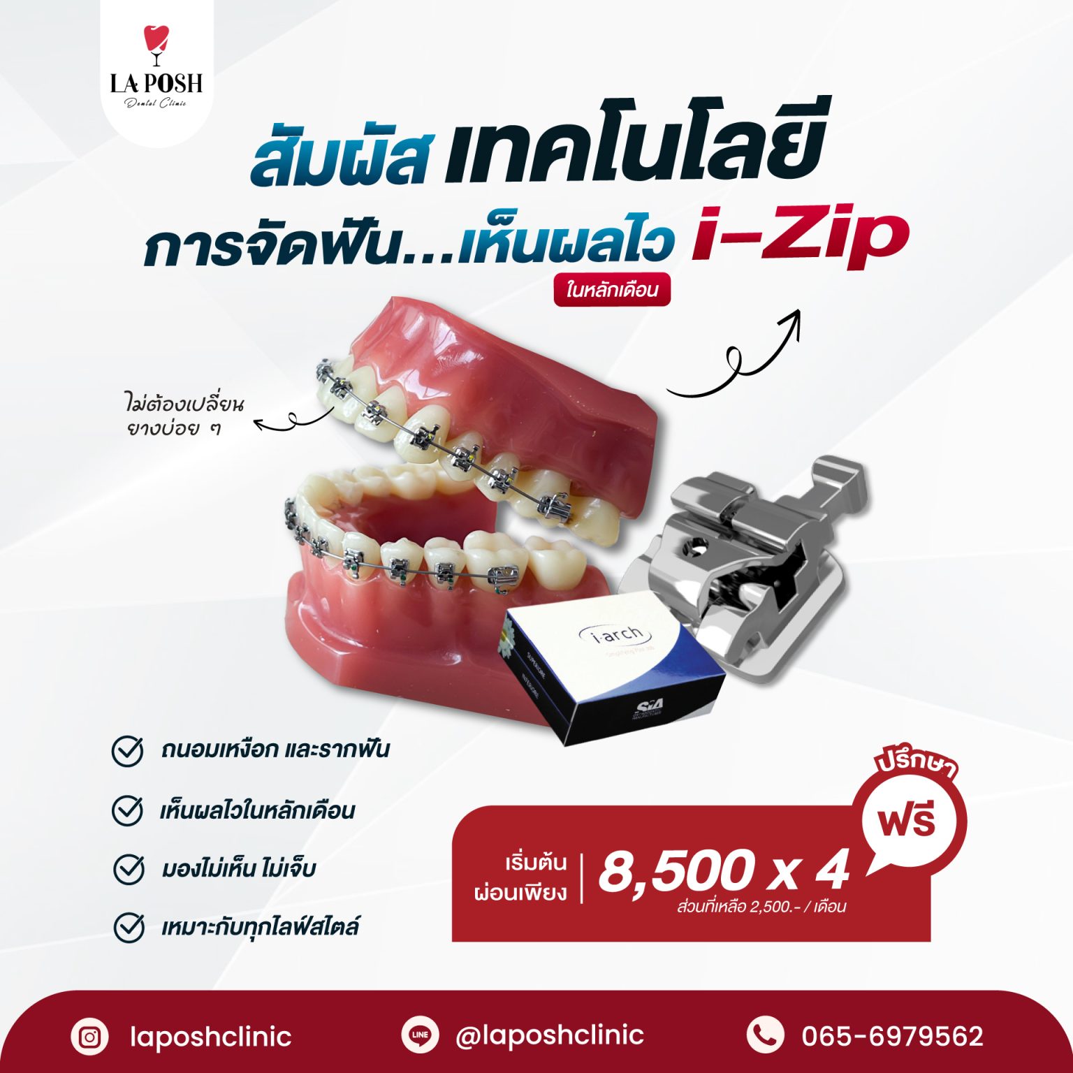 จัดฟัน i arch 4 โปรโมชั่น จัดฟันแบบดามอน จัดฟันเห็นผลด้วยเทคนิค i-zip