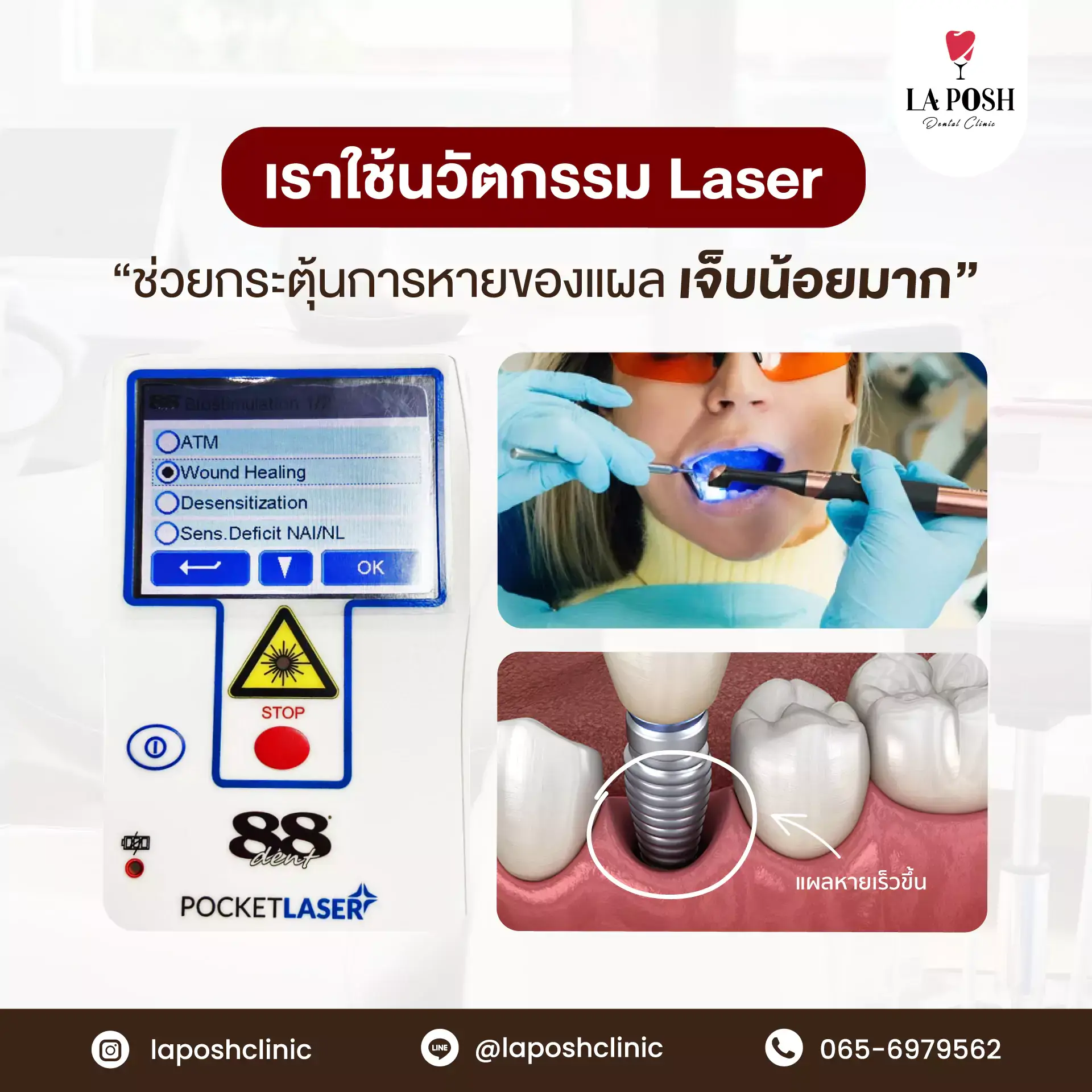 รากฟันเทียม vs ฟันปลอม