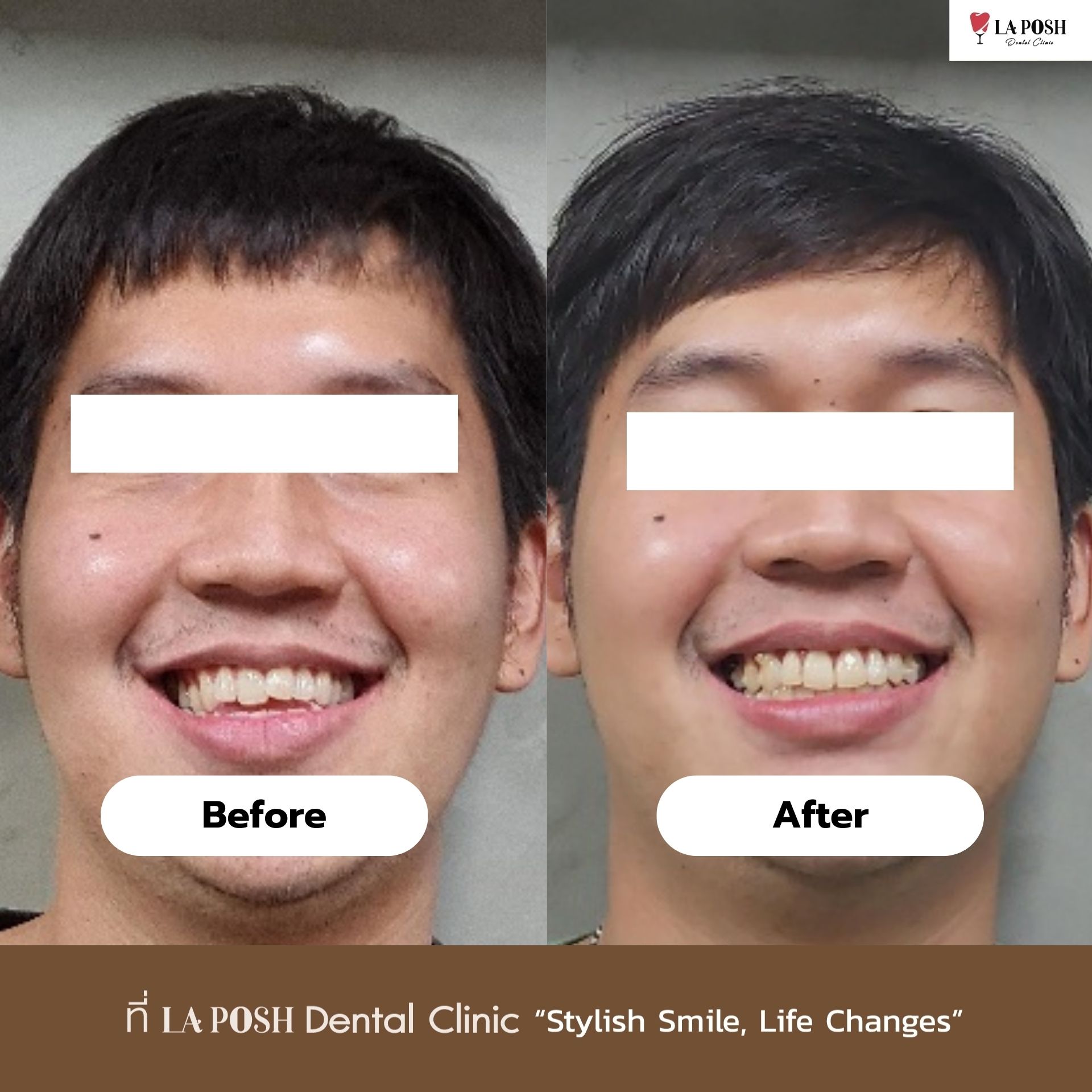 Before - After