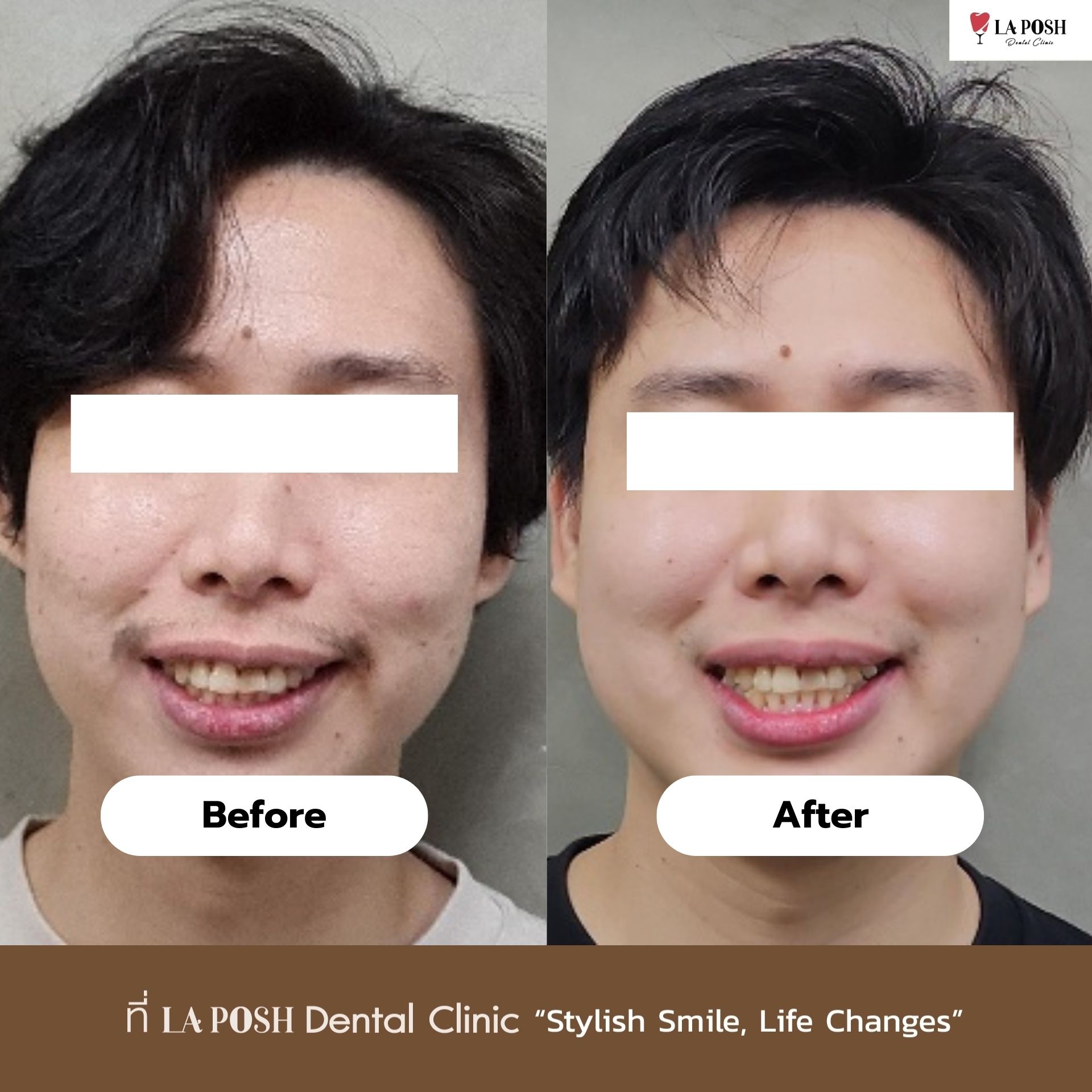 รีวิว Invisalign