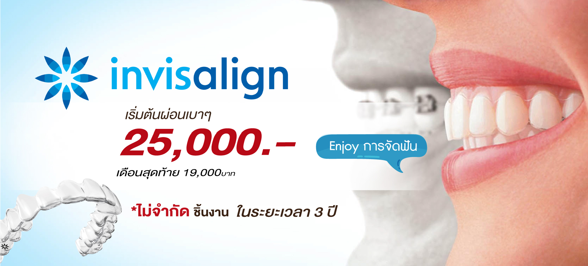 จัดฟันใส invisalign ผ่อน