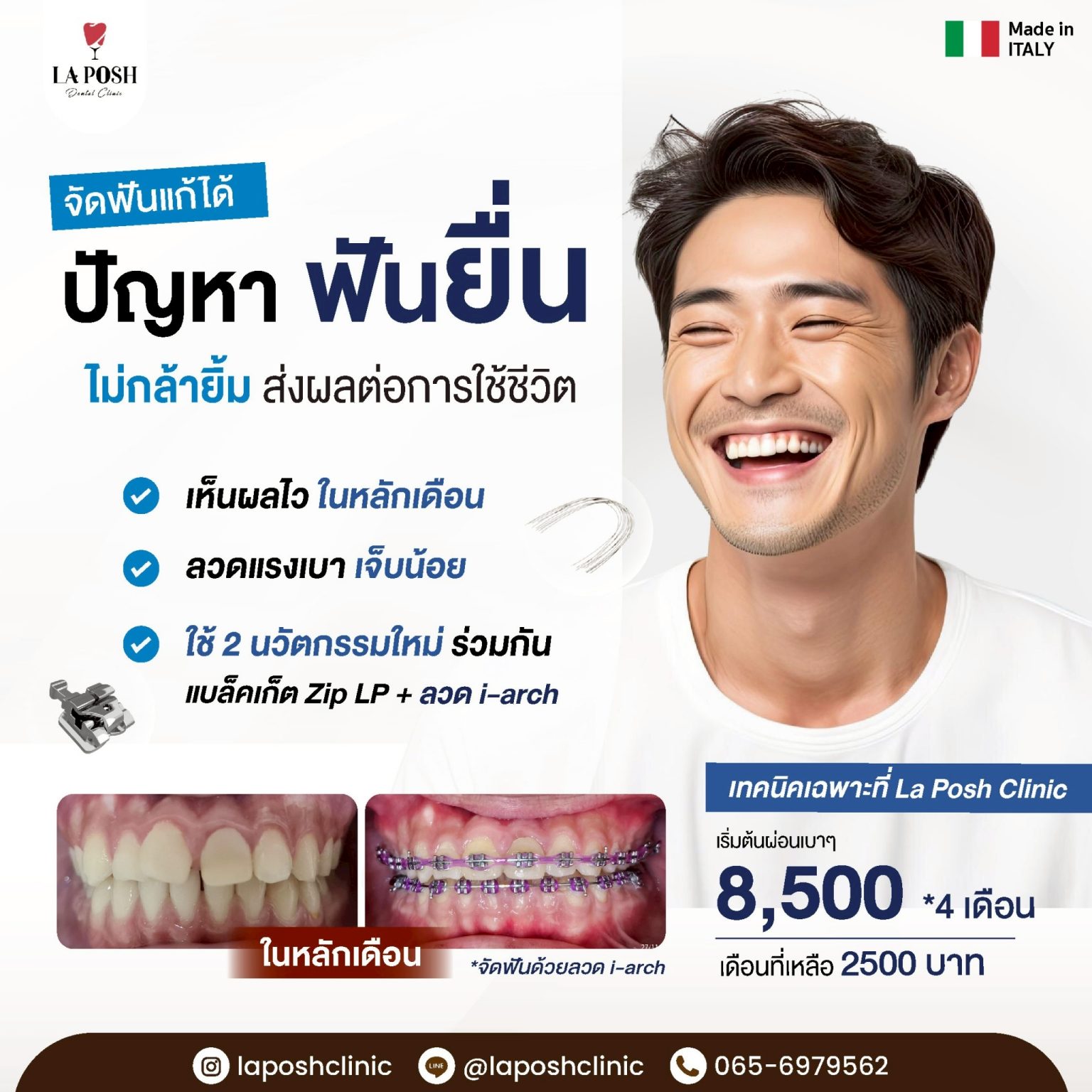 จัดฟัน i arch 3 โปรโมชั่นจัดฟัน i-Arch ที่ La Posh Dental Clinic