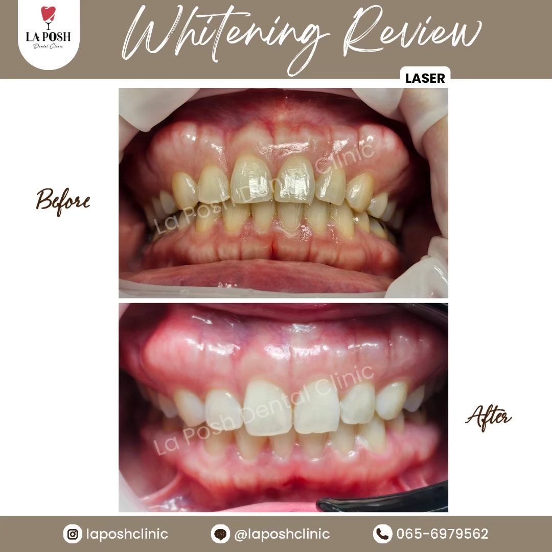 review teeth whitening