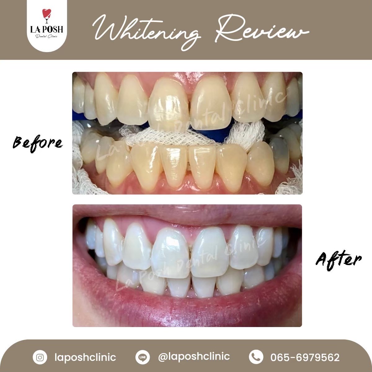 teeth whitening la posh