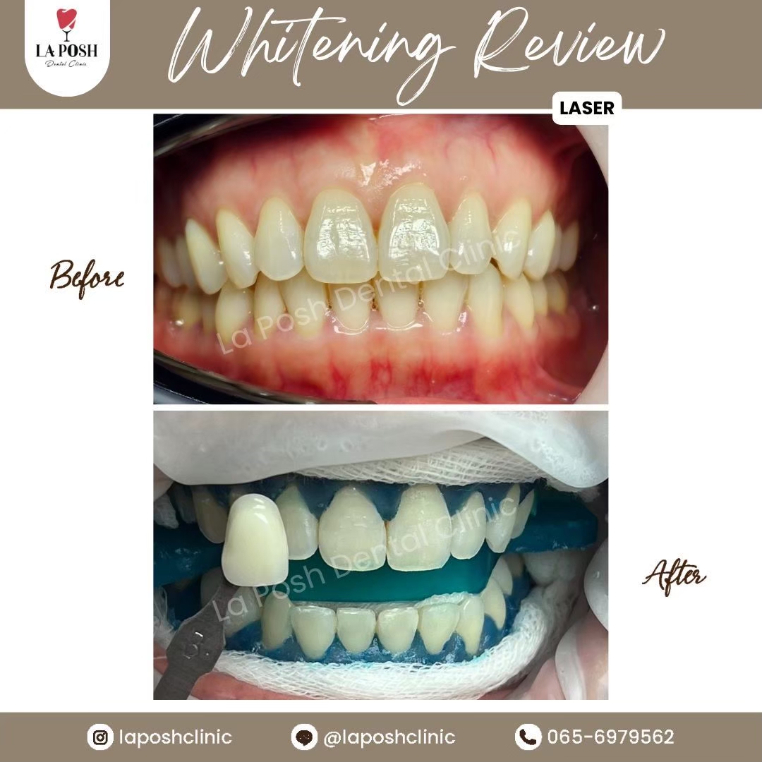 review teeth whitening la posh