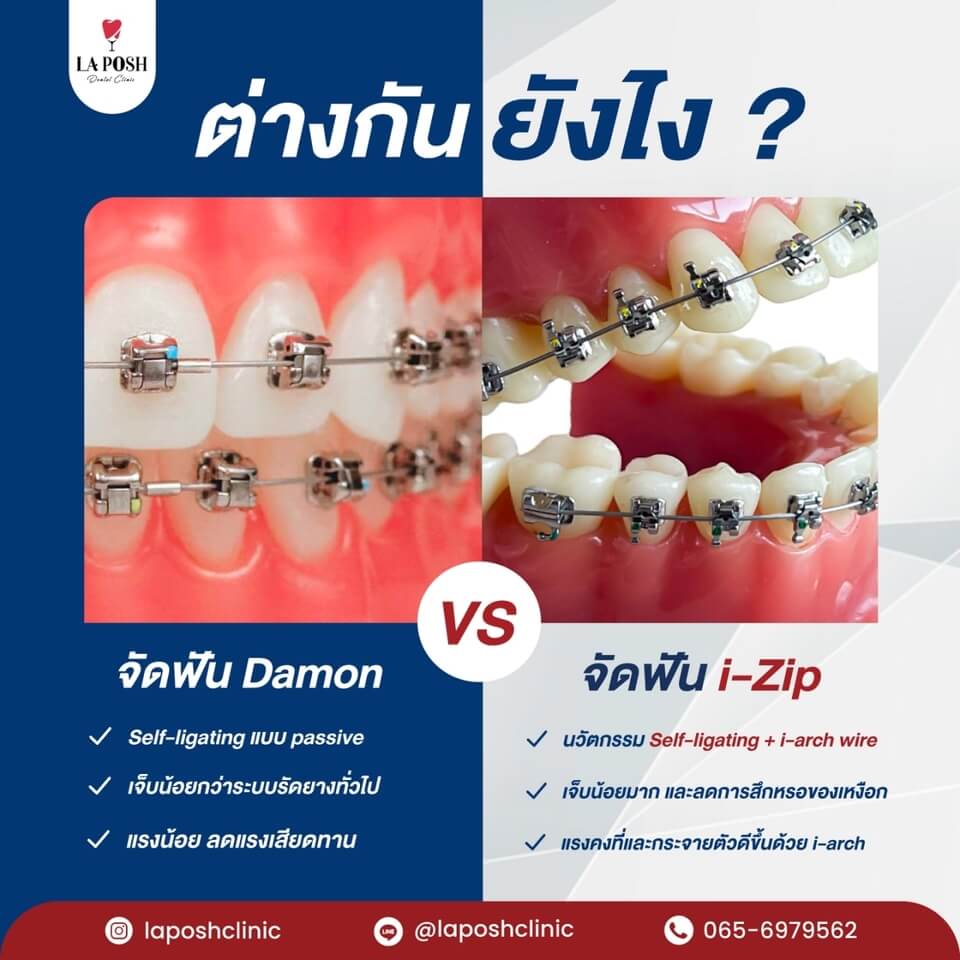 จัดฟัน i-zip ต่างกับ จัดฟัน damon ยังไง