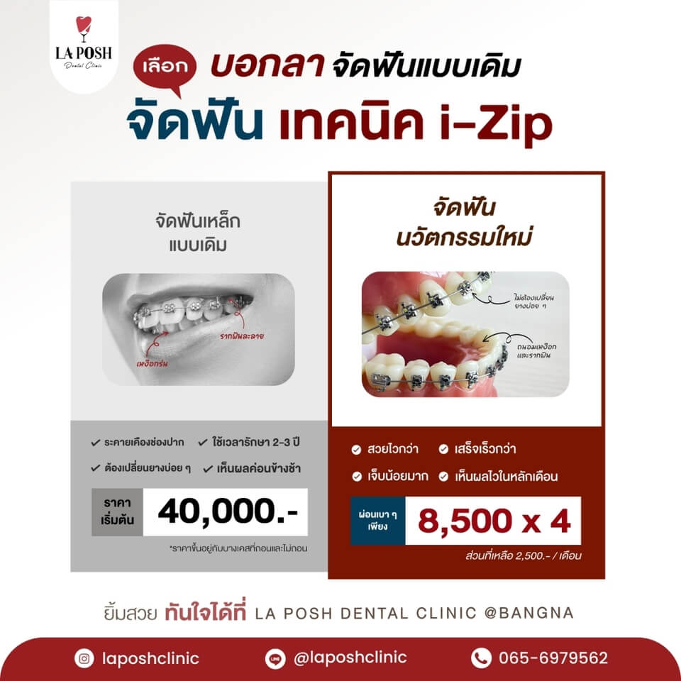 จัดฟัน i-zip ราคา