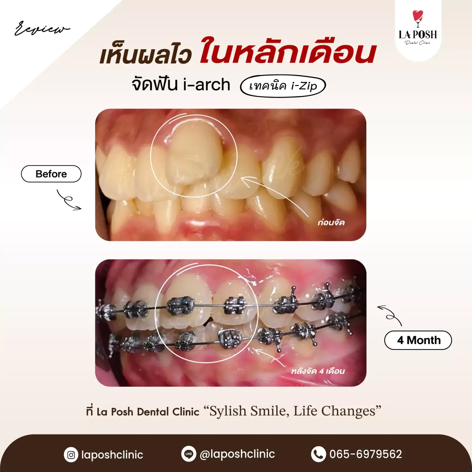 จัดฟันเหล็ก เทคนิค i-Zip 17 เคสก่อนและหลังจัดฟัน i-Arch ด้วยเทคนิค i-Clip