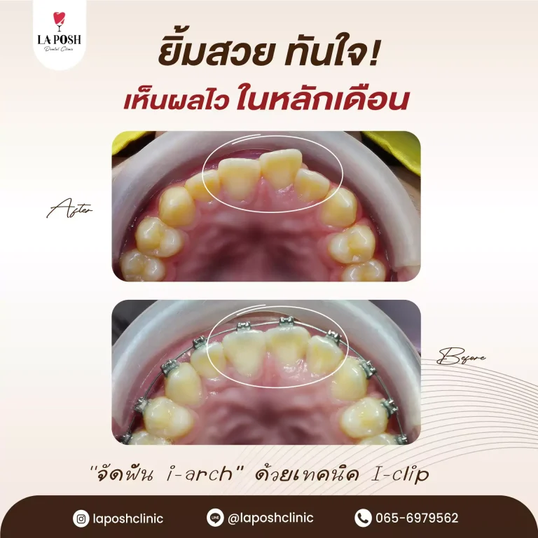 จัดฟัน i arch 10 ยิ้มสวยทันใจ