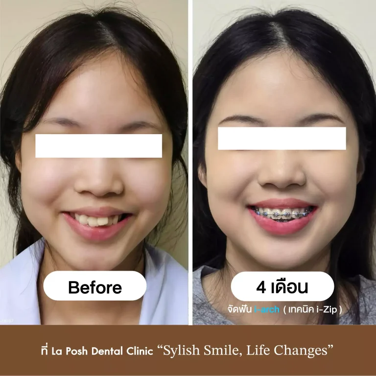 จัดฟัน i arch 7 รีวิวจัดฟัน i-Zip ก่อนและหลัง 4 เดือน